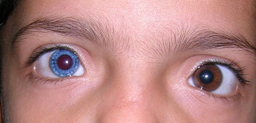 Heterochromia_Iridis.jpg